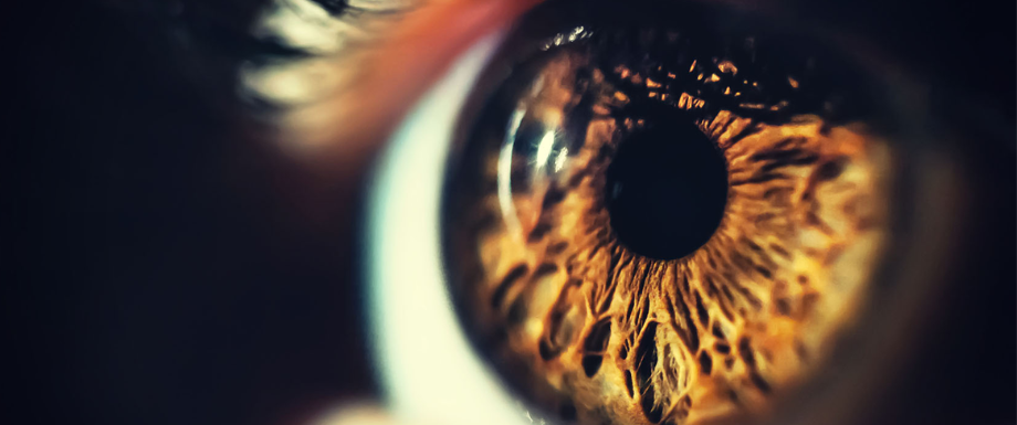 Diabetes and Eyes – Iris